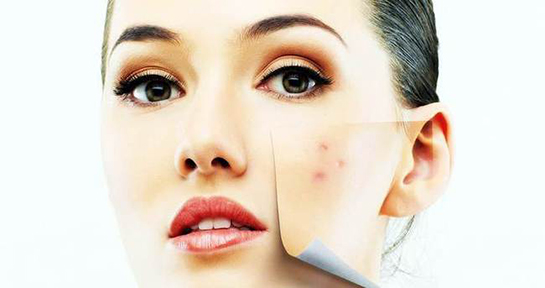 1 Günde Sivilce Geçirme Yöntemleri