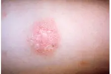 Cilt Hastalıkları Belirtileri ve Tedavisi