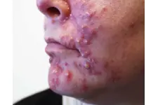 Vücutta Sivilce Belirtileri ve Tedavisi