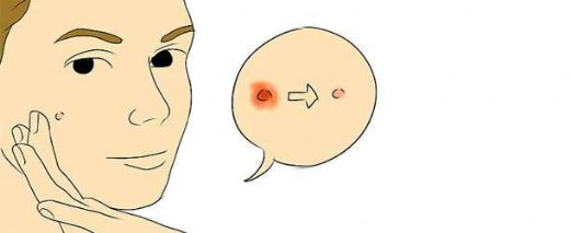 Sivilce Kızarıklığı Belirtileri ve Tedavisi