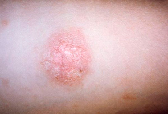 Cilt Hastalıkları Belirtileri ve Tedavisi