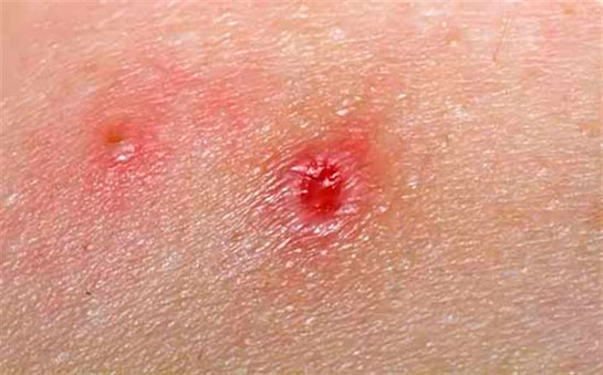 Cilt Kanseri Belirtileri