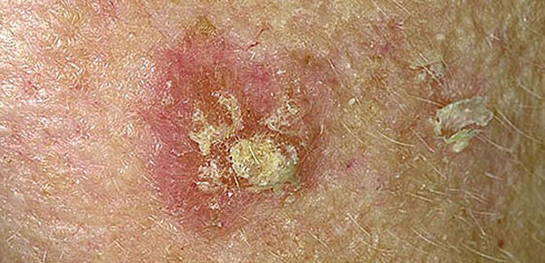 Cilt Kanseri Tedavisi