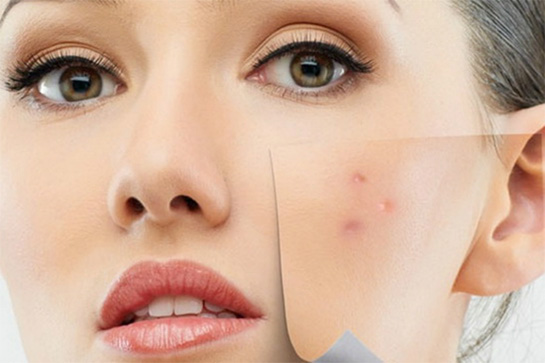 Ciltteki Sivilce Lekeleri. Oluşumu ve Tedavisi