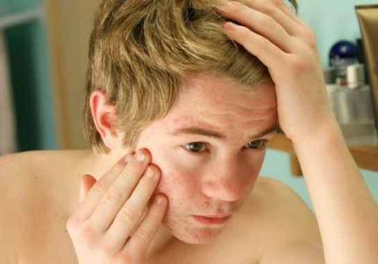 Ergenlikte Sivilce Belirtileri ve Tedavisi