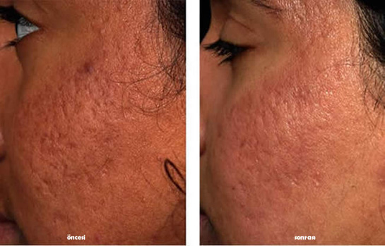 İltihaplı Sivilce ve İzleri