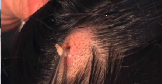 Kafada Sivilce Nedenleri ve Tedavisi