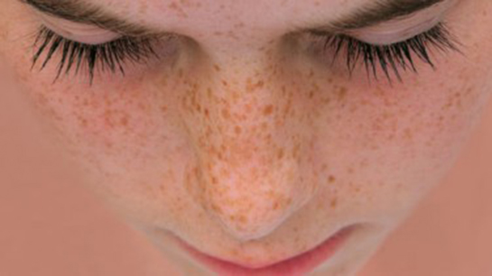 Kahverengi Sivilce Lekeleri Belirtileri ve Tedavisi