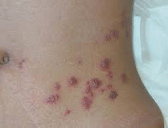 Kalçada Çıkan Sivilce Belirtileri ve Tedavisi