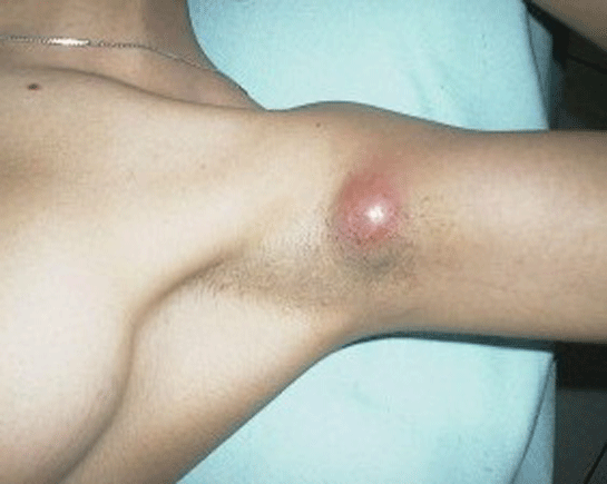 Kolda Sivilce Belirtileri ve Tedavisi