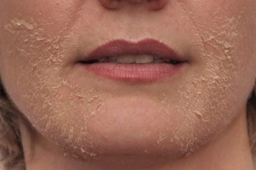 Komedon Nedir? Komedomun Faydaları Nelerdir?