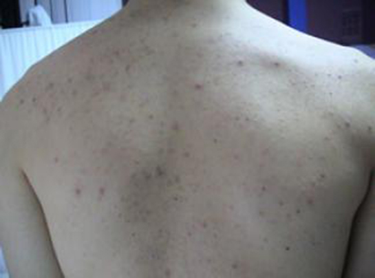 Omuzda Sivilce Nedenleri ve Tedavisi