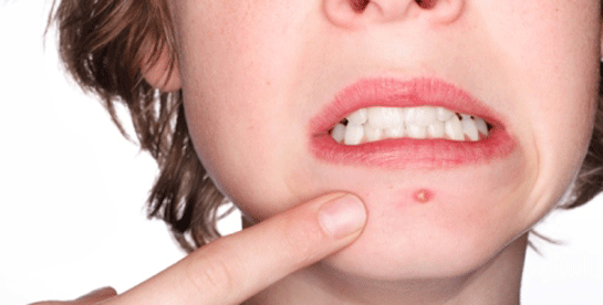 Sivilce Patlatmak Zararlı mıdır?