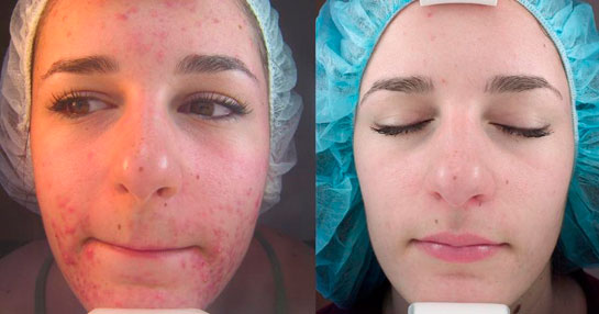 Sivilce Tedavisi Sivilce Nasıl Tedavi Edilir