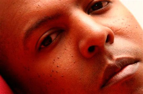 Siyah Noktalar Nasıl Geçer