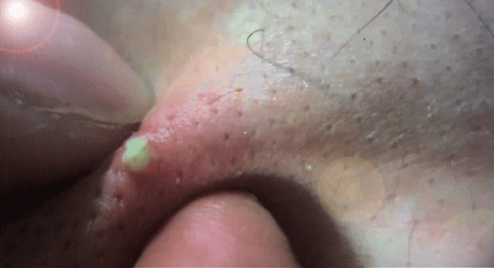 Vajinada Sivilce Belirtileri ve Tedavisi